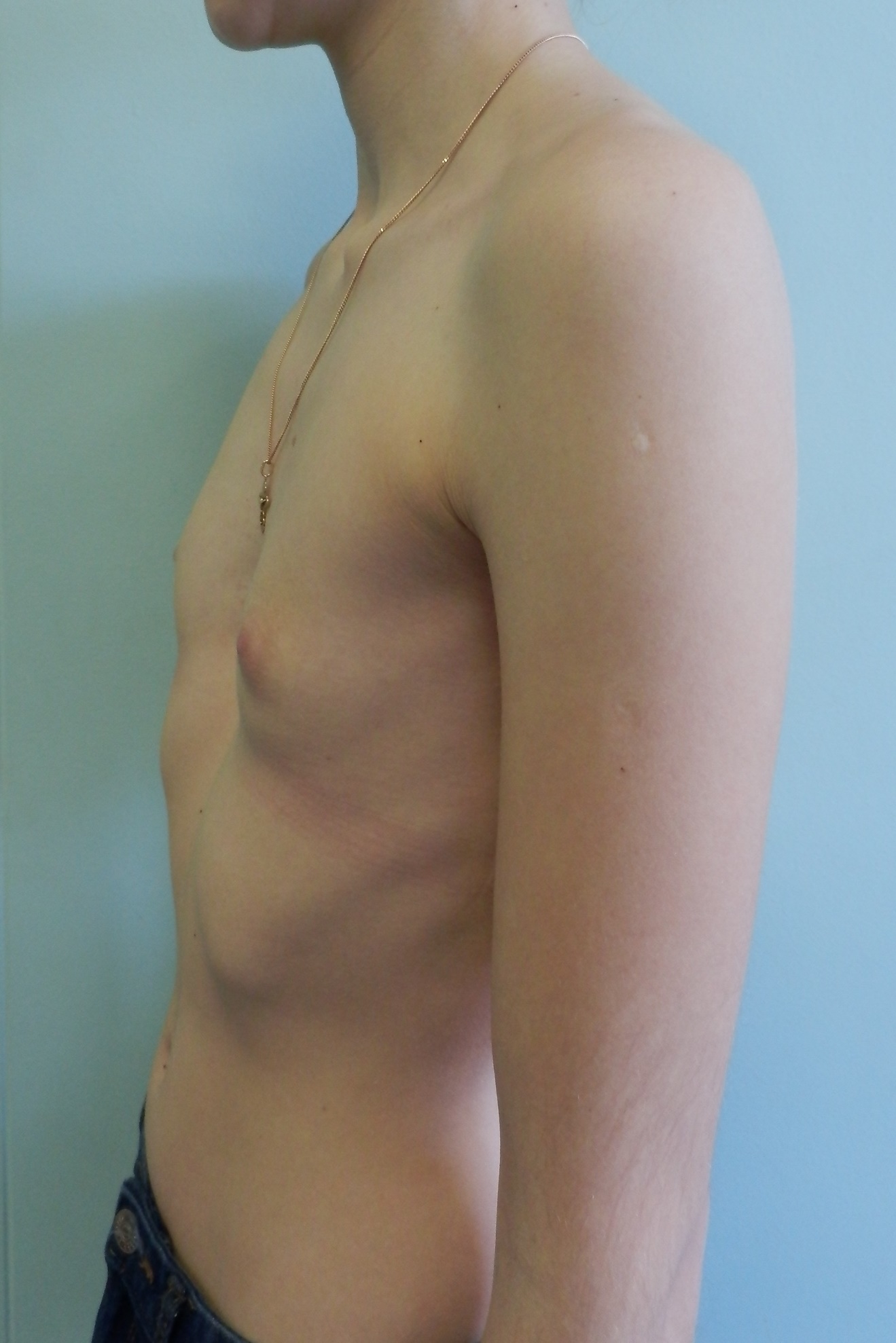 воронкообразная грудь у мужчин фото 53